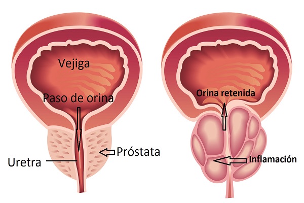 ha felmerül a prosztatagyulladás gyanúja